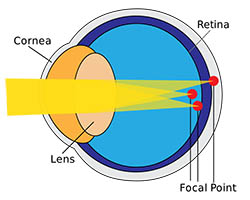 Astigmatism 