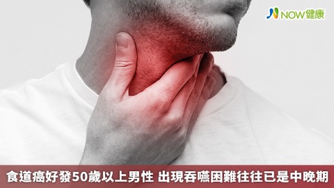 食道癌好發50歲以上男性 出現吞嚥困難往往已是中晚期