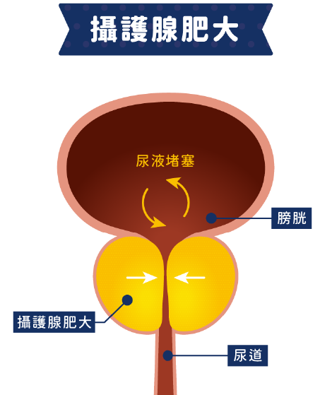 攝護腺肥大 - 圖示