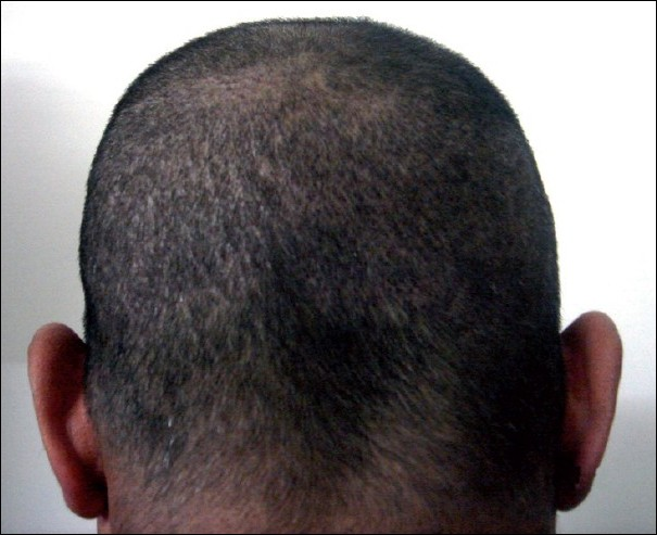 Donor area after FUE hair transplant after 7 days