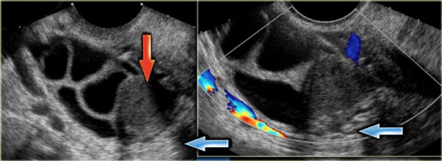 Hemorrhagic ovarian cyst