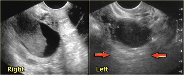 Hemorrhagic ovarian cyst in both right and left ovary