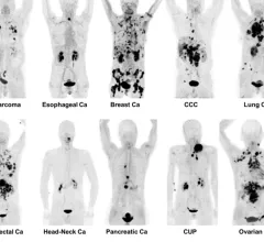 FAPI PET/CT shows promise as a better radiotracer for cancer than 18F-FDG. It also can be used for detection of infection and inflammation.