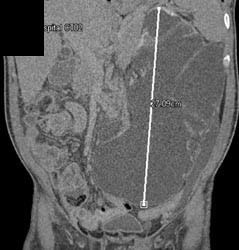 Cystic Dysplastic Right Kidney - CTisus CT Scan