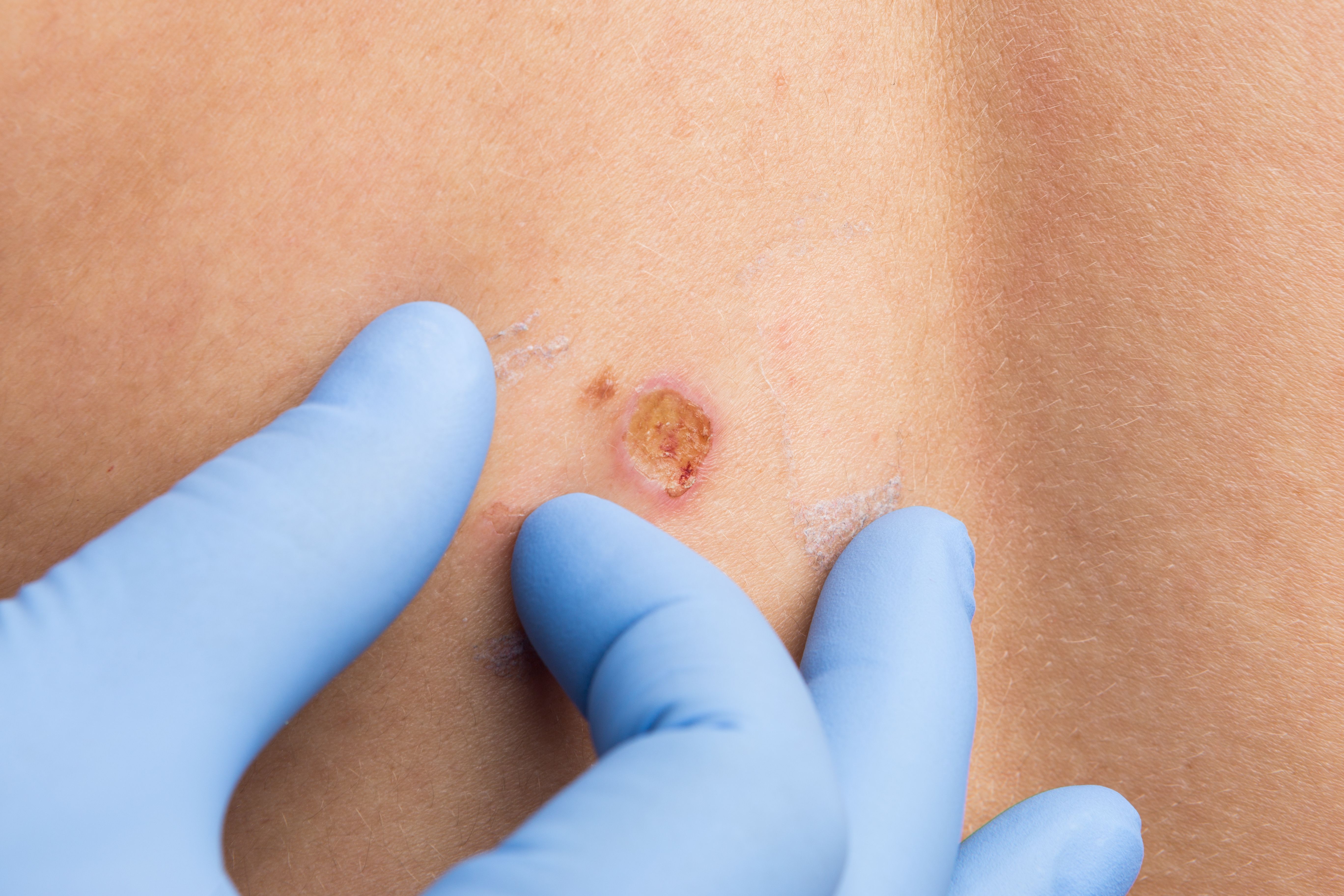 QUIZ RECAP: Treatment and Management of Skin Cancer