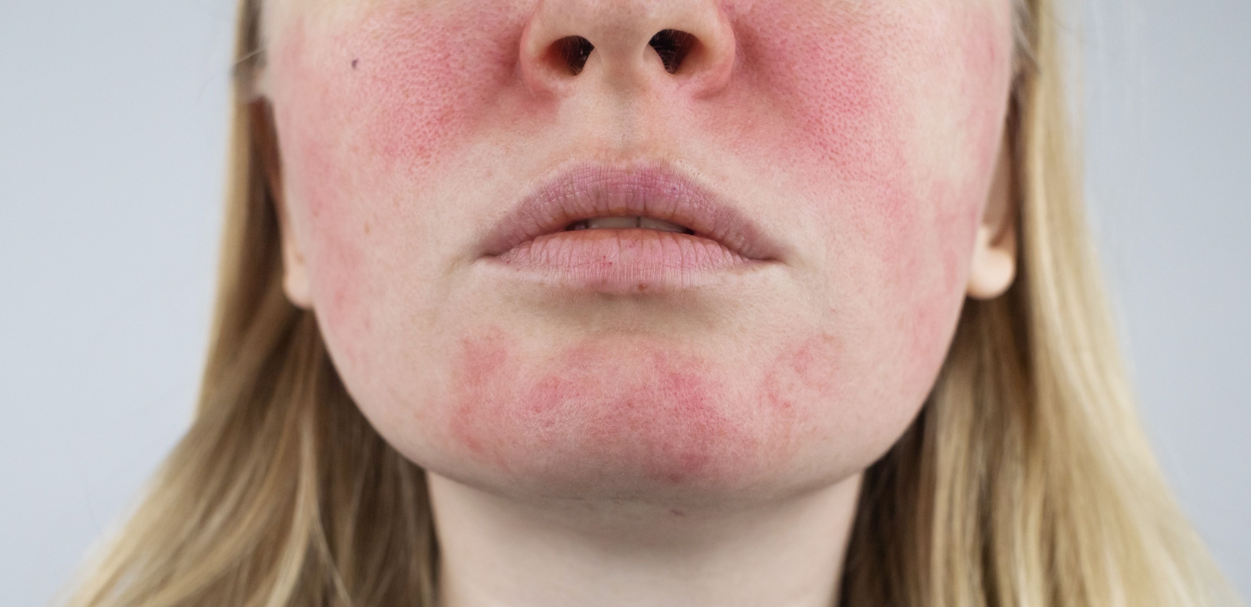 QUIZ RECAP: Test Your Knowledge of Rosacea Complications and Comorbidities