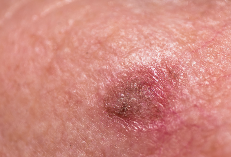 actinic keratoses