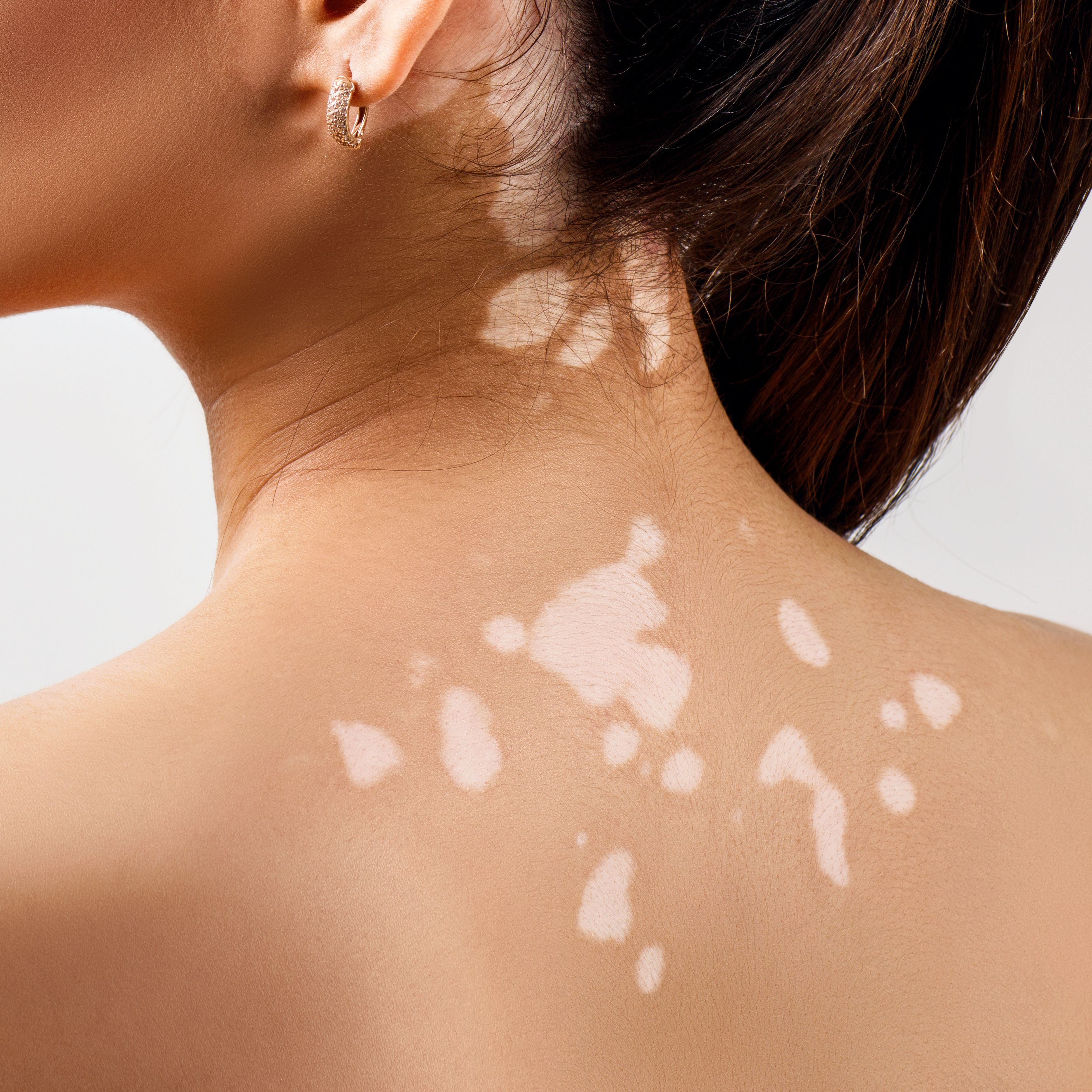 VYNE Therapeutics Initiates Phase 2b Trial of BET Inhibitor VYN201 for Vitiligo