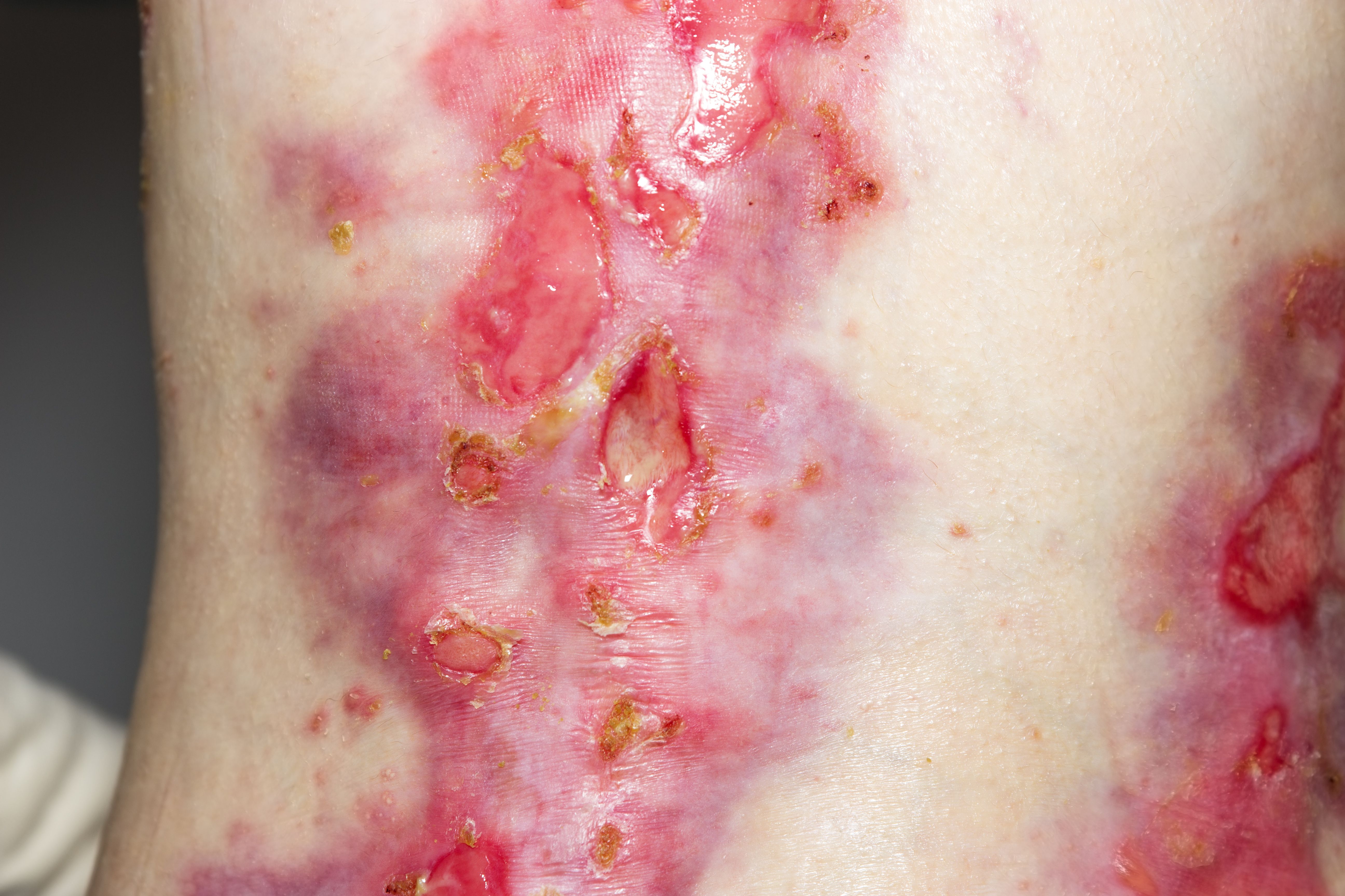 FDA Approves Topical Gel Filsuvez for Epidermolysis Bullosa