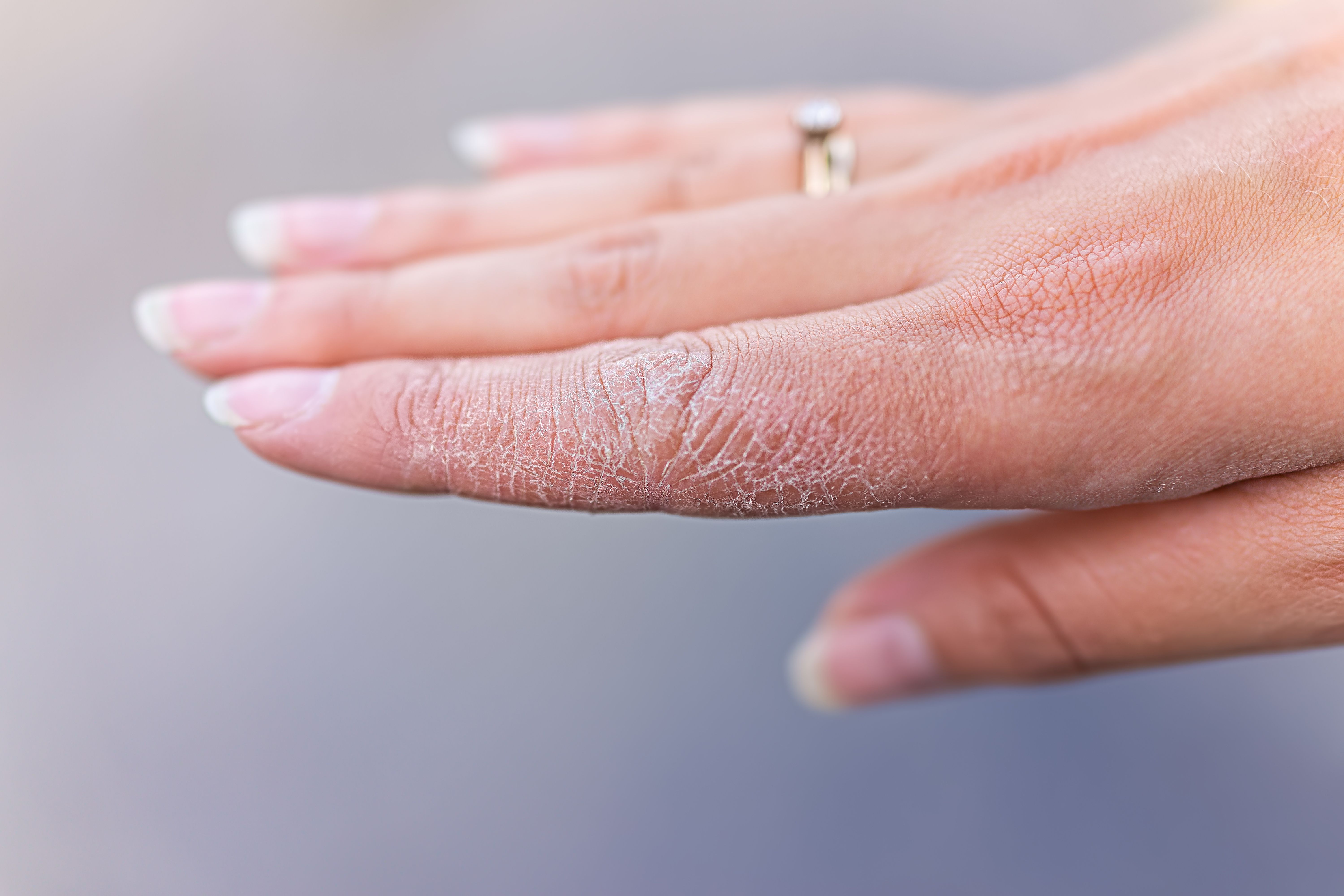 Topical Ruxolitinib Demonstrated Promising Clinical Improvements in Chronic Hand Dermatitis, Study Shows