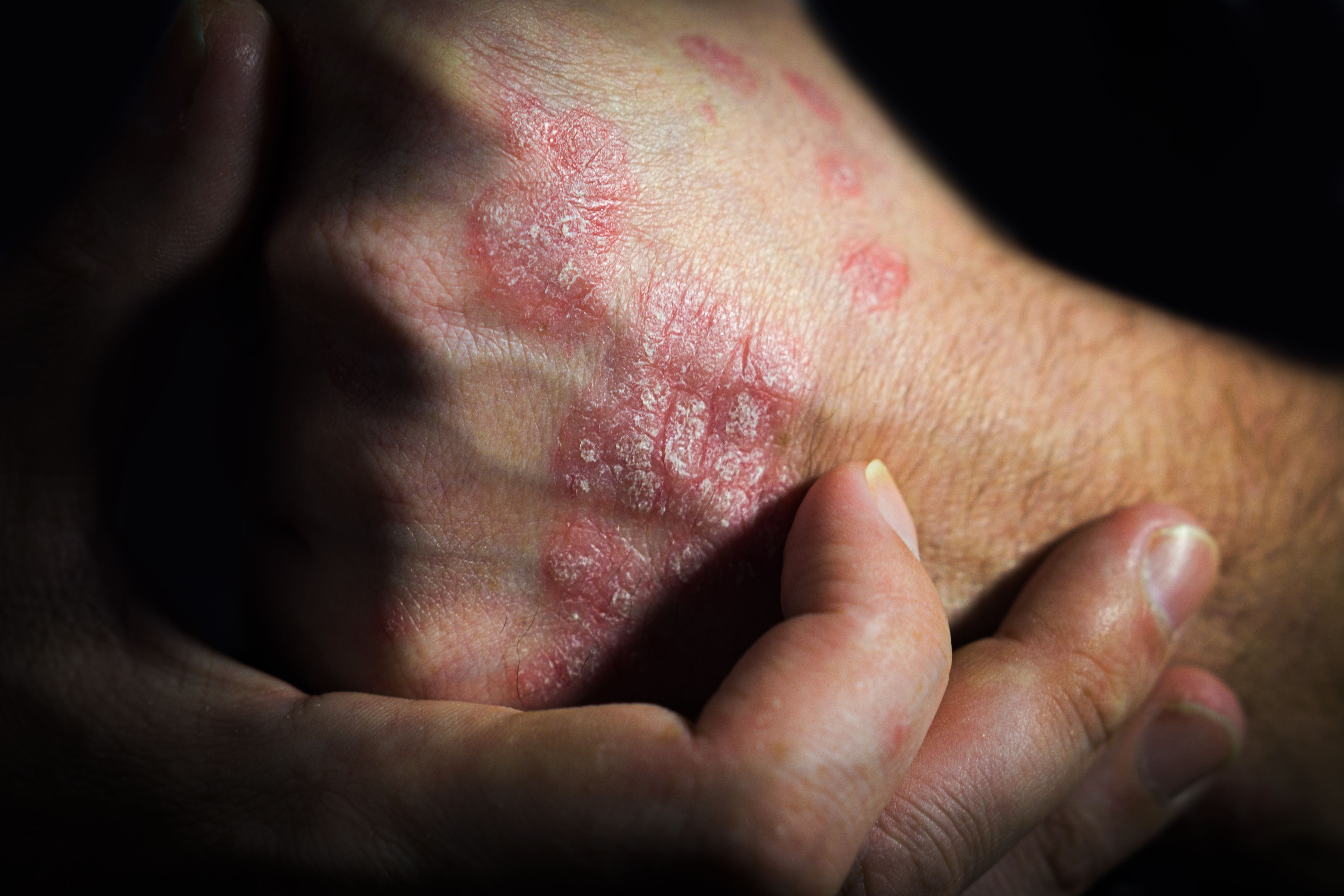 Low Stress Resilience in Men Linked to Higher Risk of Psoriasis and Psoriatic Arthritis