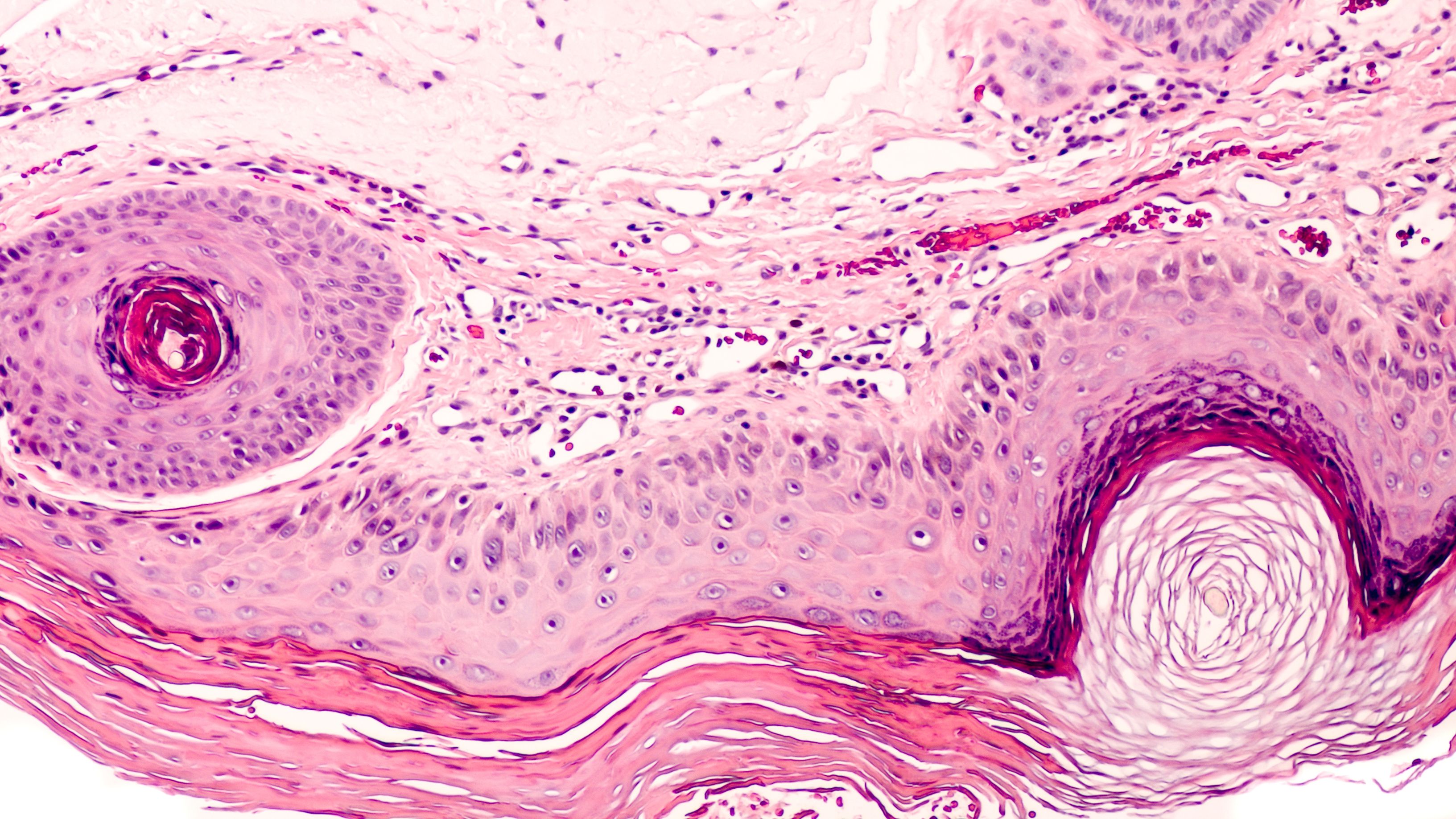  Study: Daylight PDT vs Conventional PDT for Actinic Keratosis Treatment 