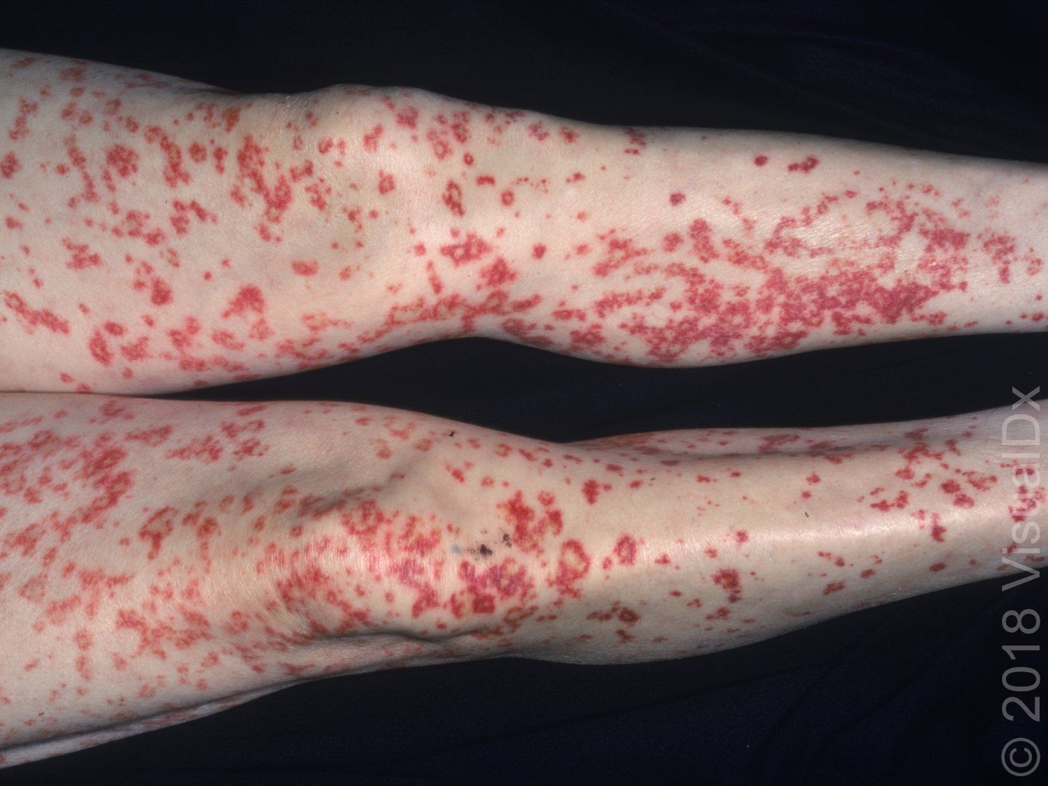 leg rash