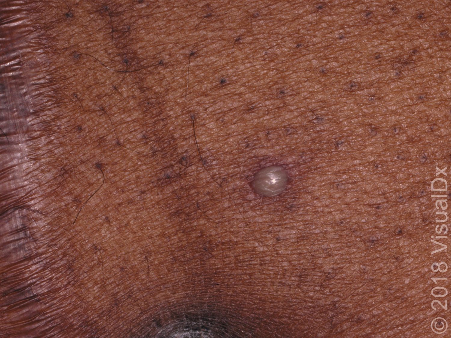 pustule on leg