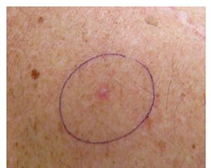 basal cell carcinoma