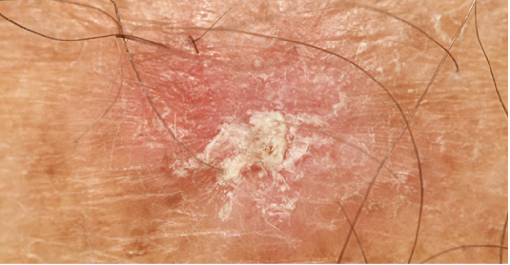 Actinic Keratosis