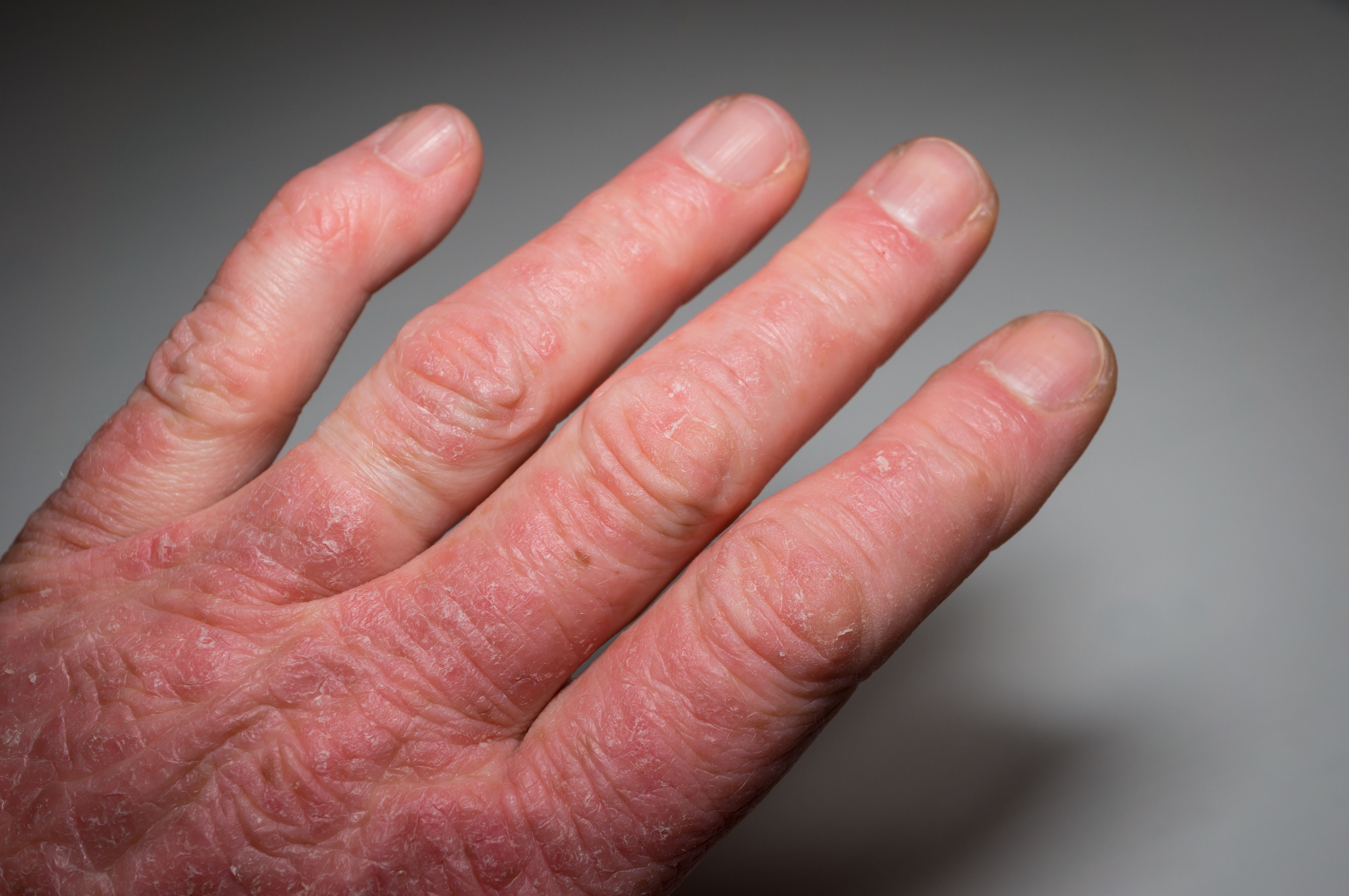 Brepocitinib More Efficacious Than Placebo in Long-Term Psoriatic Arthritis Care