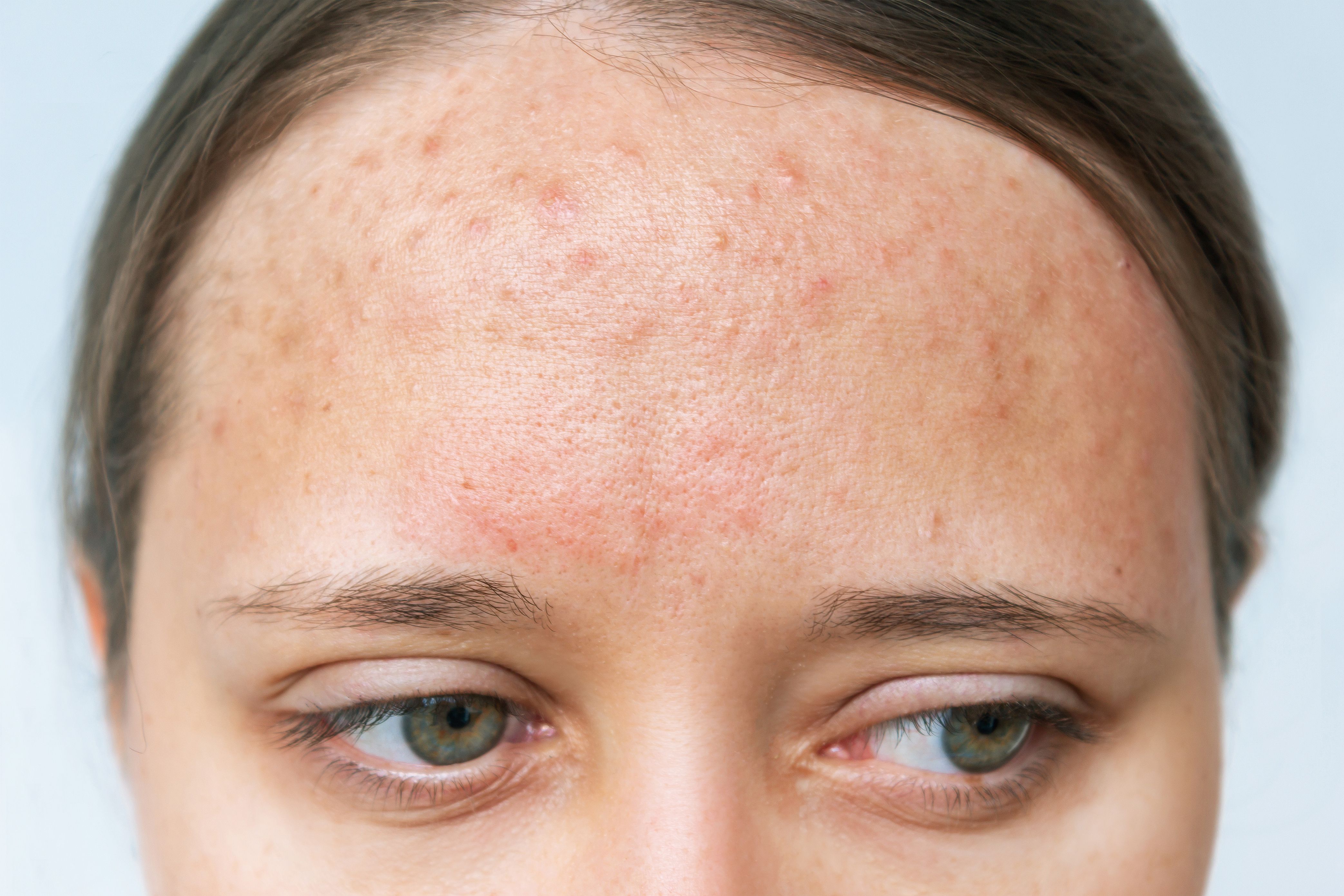 Optimizing Pediatric Acne Care with Hormonal Therapy