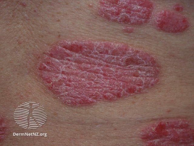 Case Report Quiz: Psoriasis Diagnosis Second Opinion 