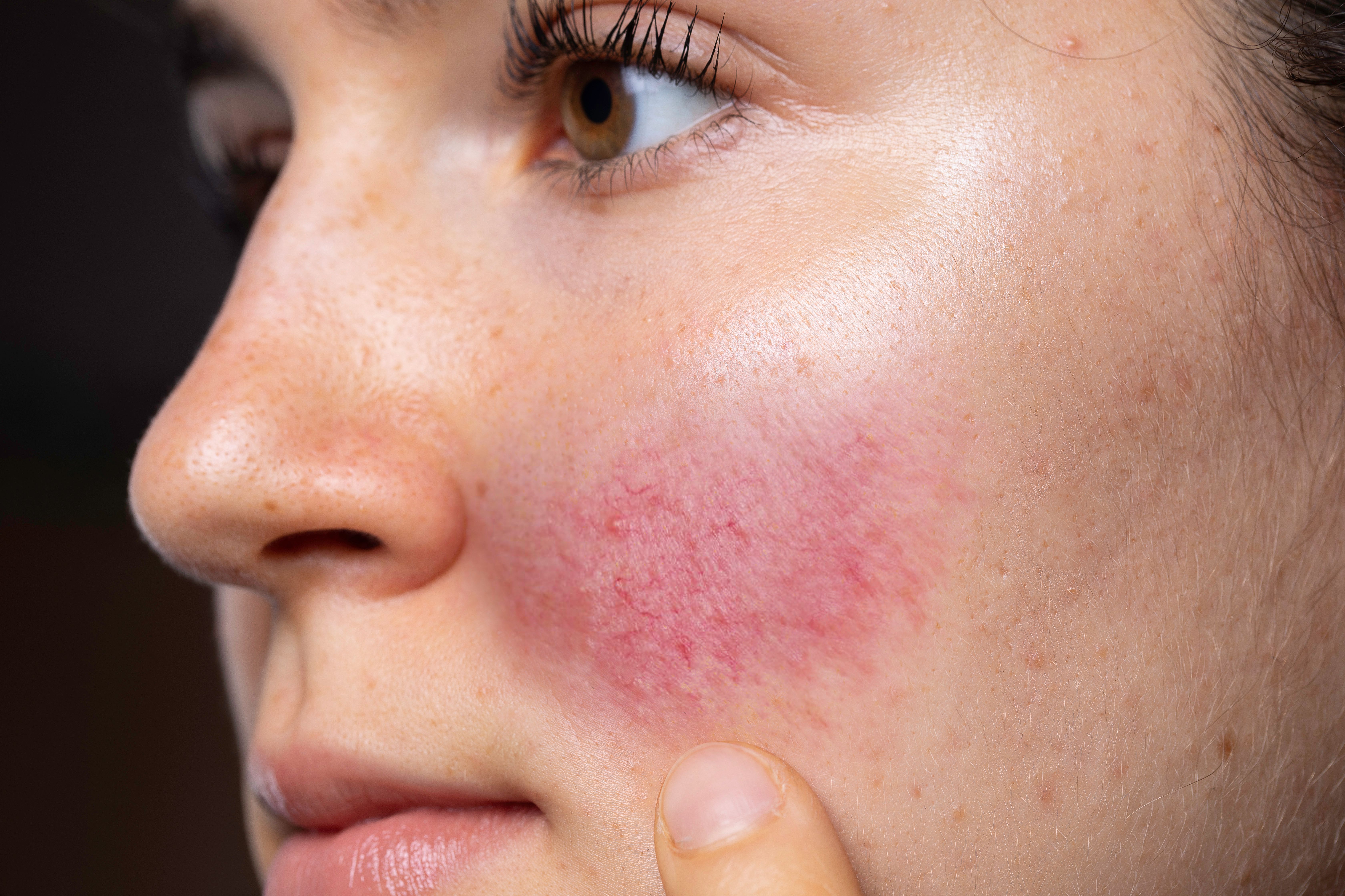 Study Investigates BTX Dosage for Rosacea Treatment