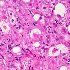 Liver tissue showing signs of NAFLD. Image by Dr David Kleiner, National Cancer Institute, NIH.