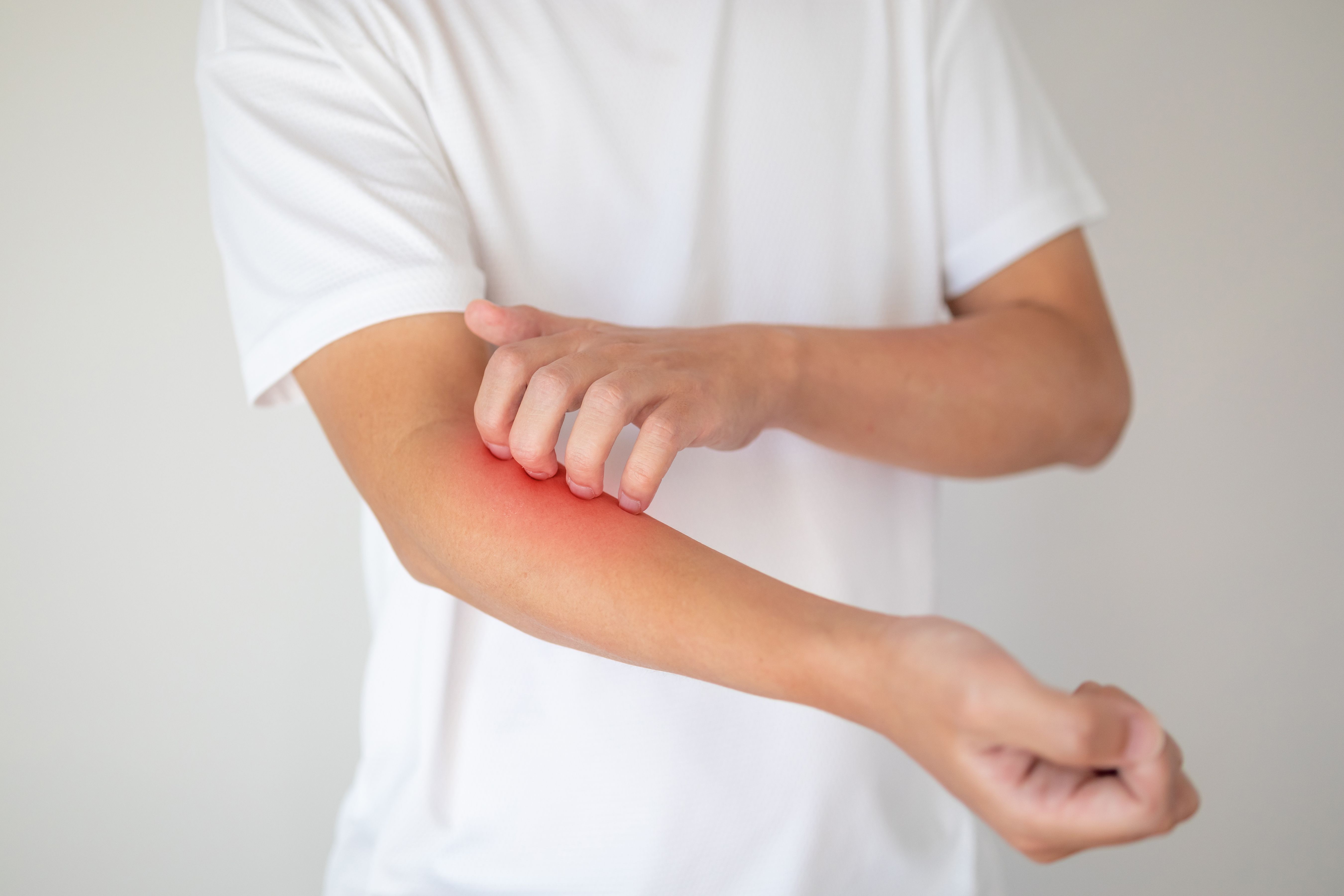 young person scratching skin that is red | Image credit: Kwangmooza stock.adobe.com