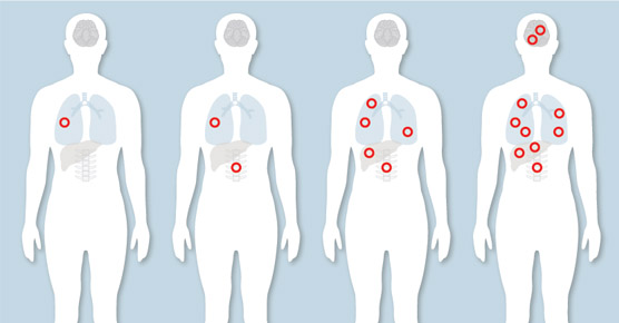 spectrum of cancer spread: localized, oligometastatic, widely diffuse metastatic disease