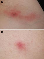 Thumbnail of Inoculation eschar on left inguinal fold (A) and vesicular skin lesion (B) in a traveler recently returned to France from Ethiopia.