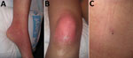 Retrospectively identified early autochthonous case of Crimean-Congo hemorrhagic fever in a woman in Spain, 2013. A, B) Erythema in the patient’s ankle (A) and knee (B) 3 days after a tick bite during a leisure walk. C) Necrotic lesion on patient’s back at site of tick bite. 