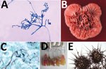 A) Ultrastructural morphology of Talaromyces marneffei, including chains of single-celled, teardrop-shaped conidia, each originating from its respective, flask-shaped phialide. Source: Libero Ajello, Centers for Disease Control and Prevention (https://phil.cdc.gov/Details.aspx?pid = 4240). B) Superior (front) view of a petri dish culture plate on which a wrinkled colony of Penicillium marneffei has been cultivated. Source: James Gathany, Centers for Disease Control and Prevention (https://phil.cdc.gov/Details.aspx?pid = 1879). C) Mouse testicle tissue specimen showing globe-shaped yeast cells of T. marneffei undergoing multiplication by binary fission not by mitosis (methenamine silver stain). Source: Libero Ajello, Centers for Disease Control and Prevention (https://phil.cdc.gov/Details.aspx?pid = 4235); D) Gradual conversion of mycelial phase of T. marneffei (growth at 25°C) to yeast phase on brain heart infusion agar after incubation at 37°C. Mycelial phase (first tube marked 25°C) shows diffusible red pigment. Source: Monika Mahajan, Postgraduate Institute of Medical Education and Research, Chandigarh, India; E) Loose network of hyphae of T. marneffei forming gymnothecium that contains asci. Source: https://istudy.pk/ascomycota-fruit-bodies/.