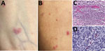 Skin lesions and testing results for a kidney transplant receipient diagnosed with Rickettsia parkeri rickettsiosis, North Carolina, USA, 2023. A, B) Sparse maculopapular rash involving forearms. Lesions ranged from 0.2 to 3 cm in greatest dimension and were tender and erythematous. C) Histopathologic appearance of rash lesion demonstrating perivascular collections of mixed inflammatory cell infiltrates in the mid-dermis comprising predominantly neutrophils and macrophages. Hematoxylin and eosin stain; original magnification ×50. D) Immunohistochemical detection of antigens of R. parkeri (red) in dermal inflammatory cell infiltrates. Immunoalkaline phosphatase with naphthol-fast red and hematoxylin counterstain; original magnification ×100.