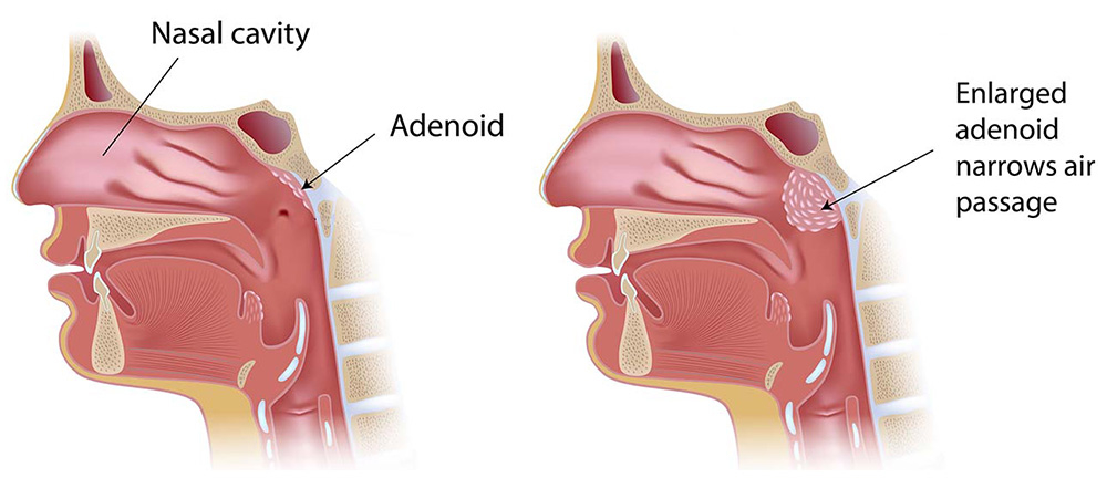 Illustration showing an enlarged adenoid.