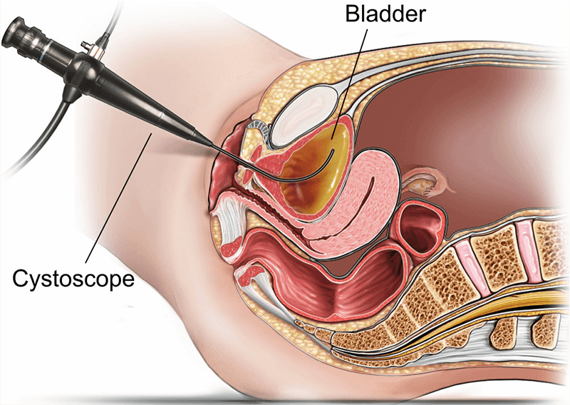 Illustration showing a flexible cystoscopy (female).