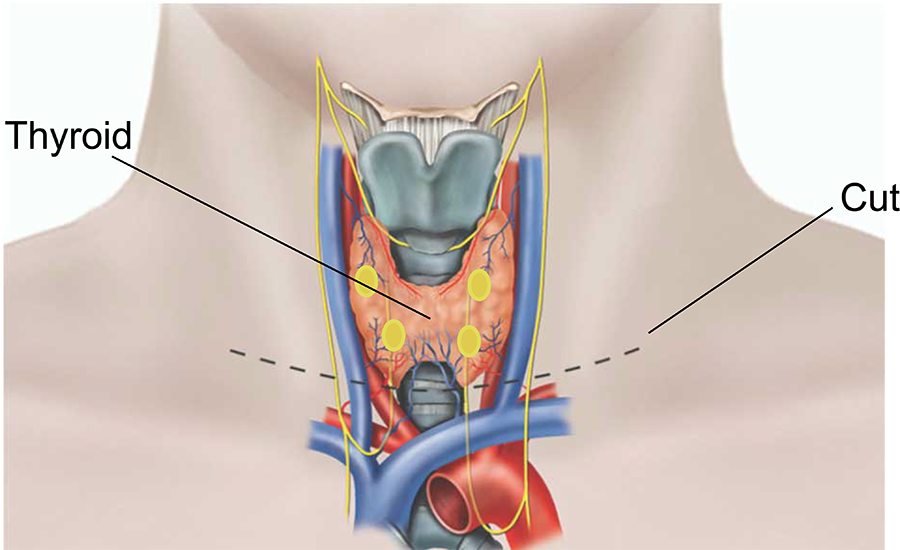 Illustration showing a thyroidectomy.