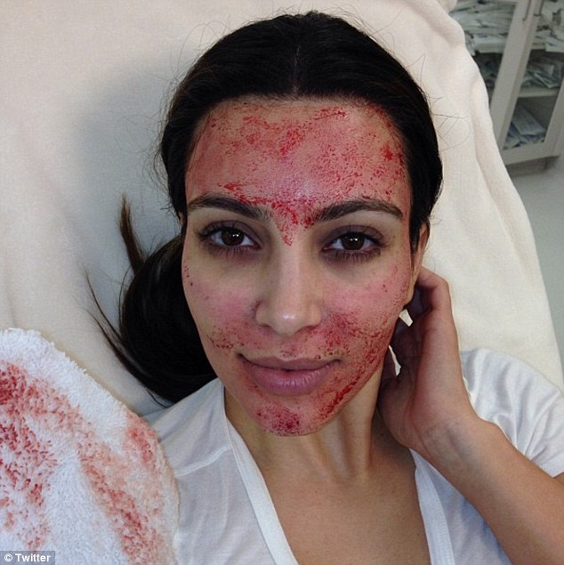 No início deste ano, Kim Kardashian quis mostrar seu novo tratamento estético que consistia em aplicar seu próprio sangue no rosto. Mas a noiva de Kanye West acabou assustando os seguidores de uma rede social com o rosto todo ensaguentado