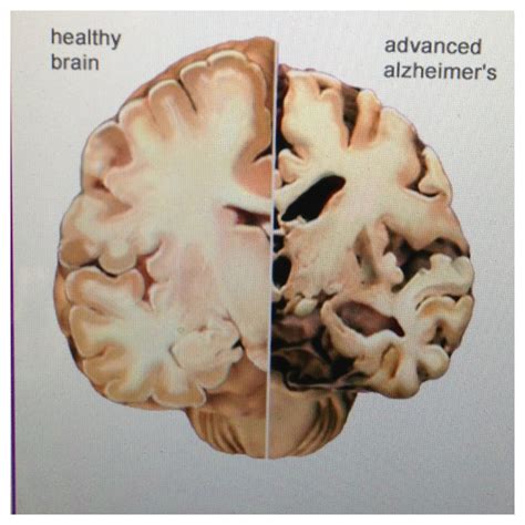 Does Dementia Eat Your Brain at Jared Wallace blog