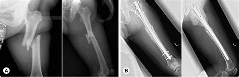 Applications of expert asian femoral nail. (A) Preoperative radiographs... | Download Scientific ...