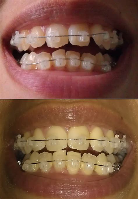 Invisible braces before and after - ferytheatre