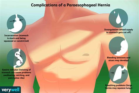 Hernia Conference 2024 - Yetty Madelene