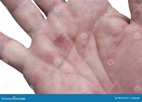 HFMD - Hand Foot And Mouth Disease - Viral Diseases Stock Image | CartoonDealer.com #84113701