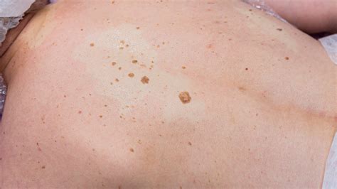 Can Age Spots Be Raised? Exploring The Truth Behind Skin Bumps