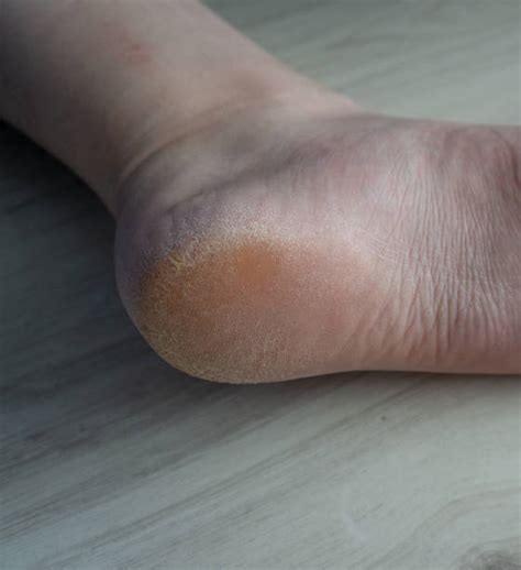 Best Human Foot Human Skin Sole Of Foot Peeling Stock Photos, Pictures & Royalty-Free Images ...