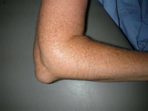 Elbow (Olecranon) Bursitis - OrthoInfo - AAOS