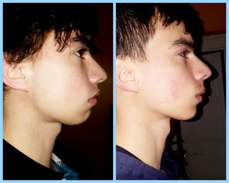 6 Month Mewing transformation (18M) : r/Mewing