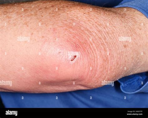 Infected olecranon bursitis in an 86-year-old male patient. Olecranon bursitis is inflammation ...