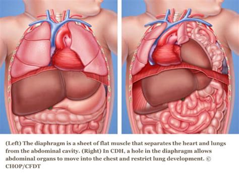 What Is Congenital Diaphragmatic Hernia? | The Incredible Teddy Foundation