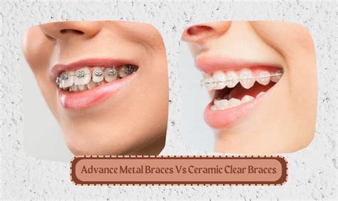 Advance Metal Braces Vs Ceramic Clear Braces