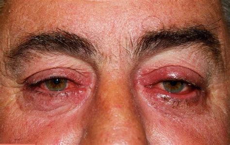 Ocular Rosacea - Causes, Triggers, Symptoms, Eye Drops, Treatment