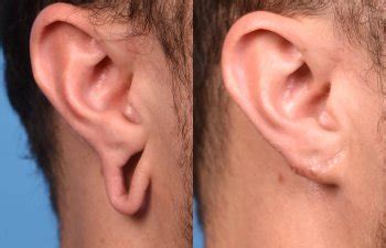 Treating Stretched or Torn Earlobes | Salt Lake City, UT