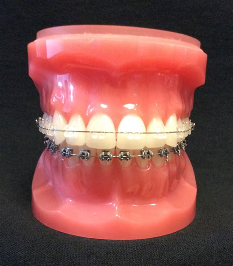 Types of Braces: Ceramic Braces | Charleston Orthodontic Specialists